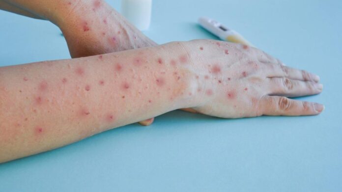 mpox_variola_do_macaco OMS declara Mpox, anteriormente conhecida como Varíola do Macaco, emergência internacional de saúde pública